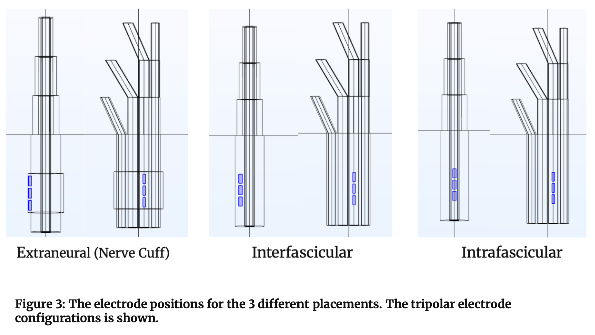 Figure 3. Tripolar electrode configurations for extraneural, interfascicular, and intrafascicular placements.